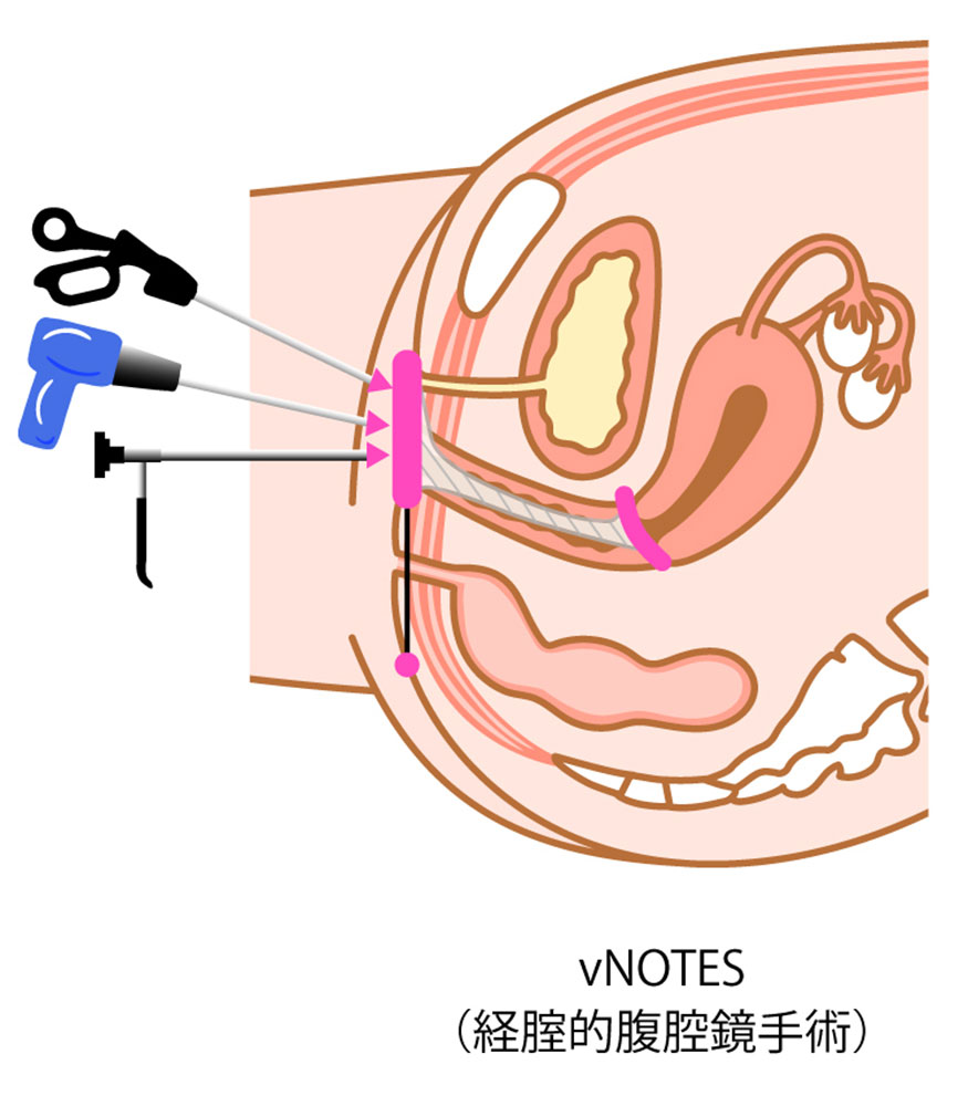 vNOTES（経腟的腹腔鏡手術）イラスト
